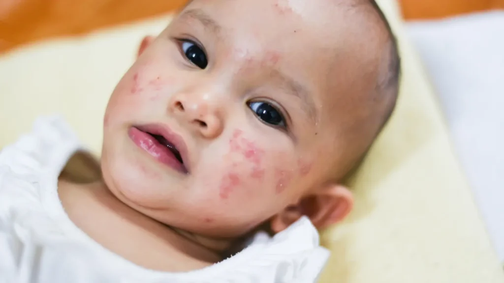 Childhood Allergies Guide: Symptoms & Management