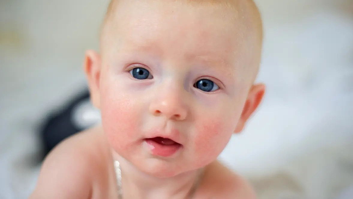 Eczema (Atopic Dermatitis)