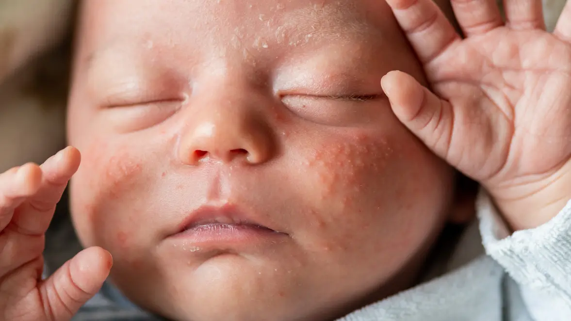 Fifth Disease