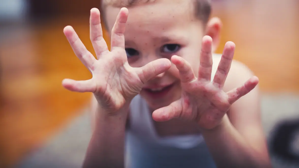 Hand, Foot & Mouth Disease