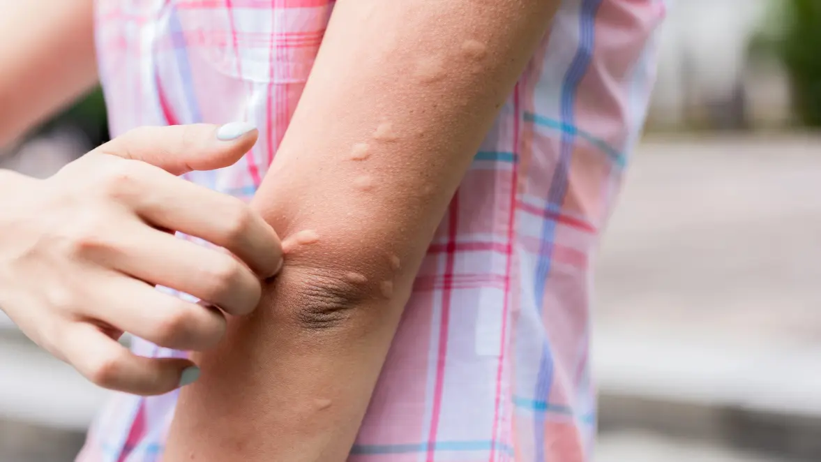 Lyme Disease