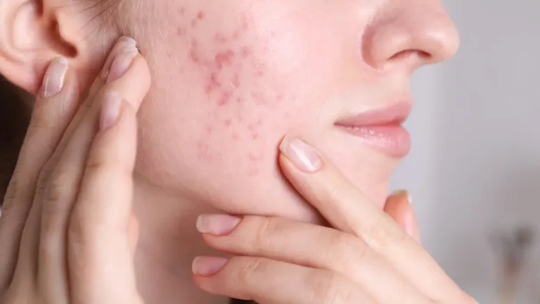 Skin Changes During Pregnancy