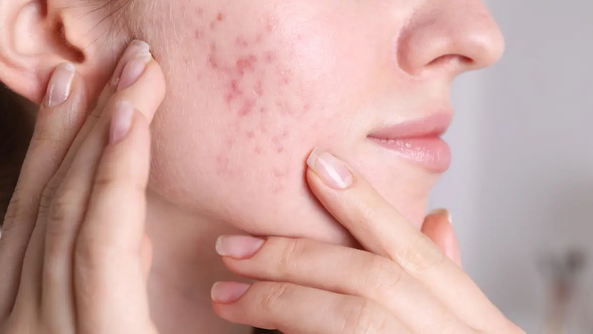 Skin Changes During Pregnancy