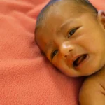 Newborn Jaundice